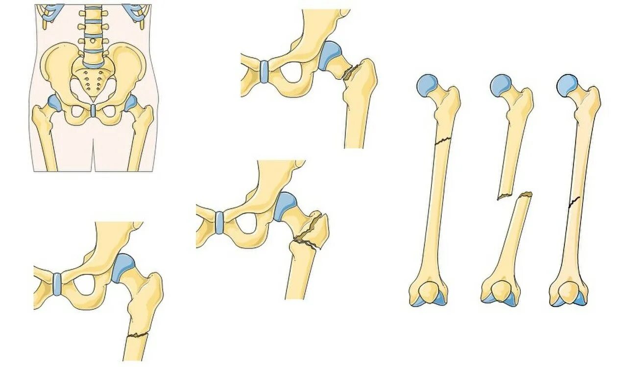 6 недель перелом. Перелом диафиза бедренной кости классификация. Бедренная кость перелом диафиза. Перелом в/3 бедренной кости. Диафиза левой бедренной кости.
