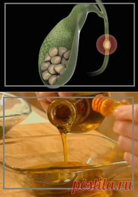 Таблетки для растворения желчных камней. Растворить желчных камнях без операции. Желчекаменная болезнь холестериновые камни. Растворить желчных камнях без операции. Растворение конкрементов желчного пузыря.