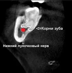 Удаление тройничного нерва зуба