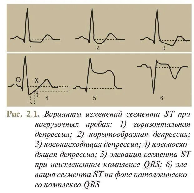 Эпизод депрессии st. Элевация сегмента St на ЭКГ. Депрессия St в отведениях v2-v6. Депрессия и элевация сегмента St. Депрессия St на ЭКГ В v5 v6.