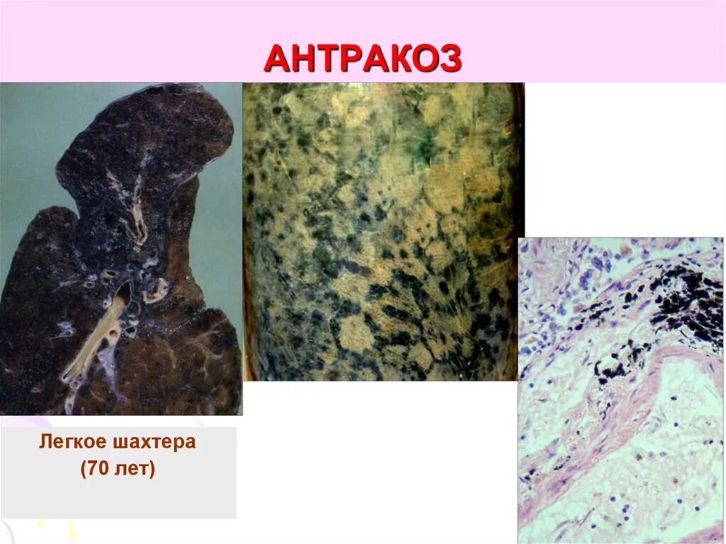 профессиональные заболевания легких. макропрепаратантрако силикоз легкого. антракоз легкого макропрепарат. легкие шахтера. профессиональные болезни горняков.