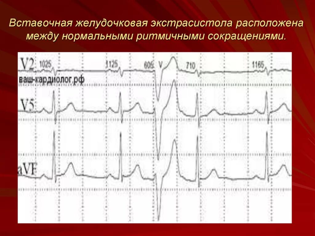 Вставочные экстрасистолы