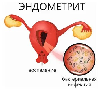 Воспаления слоя матки