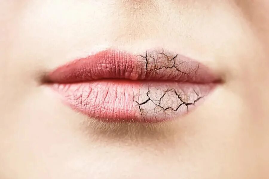 Broken lips