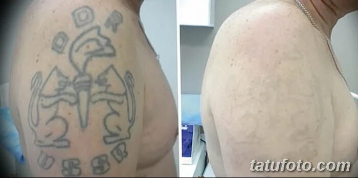 Выведение татуировок лазером. Лазерное сведение тату. Шрамы после удаления татуировок. После сведения тату остается шрам. После сведения тату остается шрам.