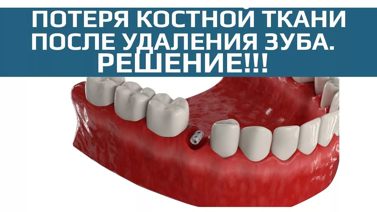 Подсадка костной. Атрофия костной ткани челюсти. подсадка кости в стоматологии. костная пластика в стоматологии. подсадка костной ткани в стоматологии.