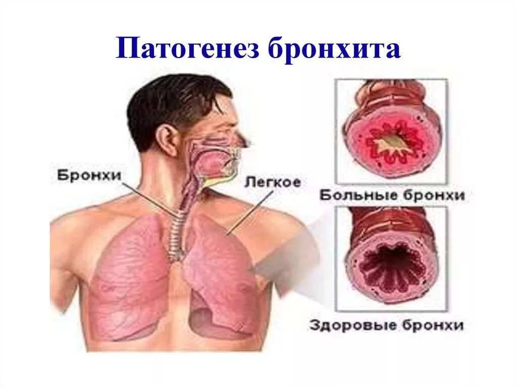 Бронхит бронхи. Патогенез бронхита. Этиология острого бронхита. Хронический бронхит этиология.