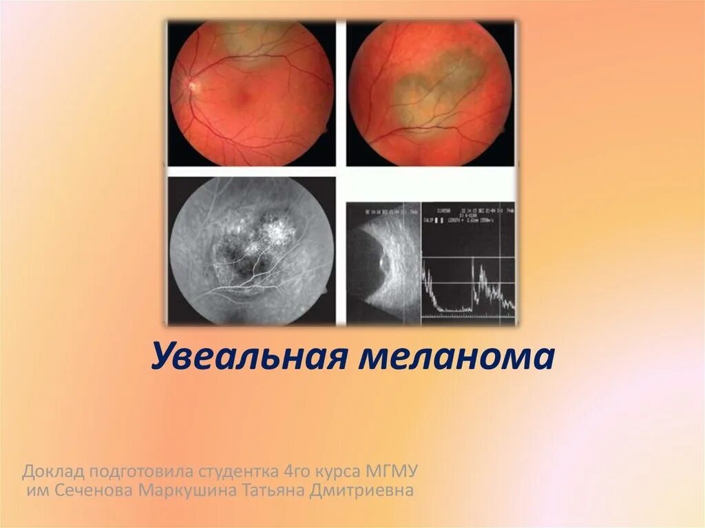 Как отличить родинку от меланомы - Арт Минск.ру