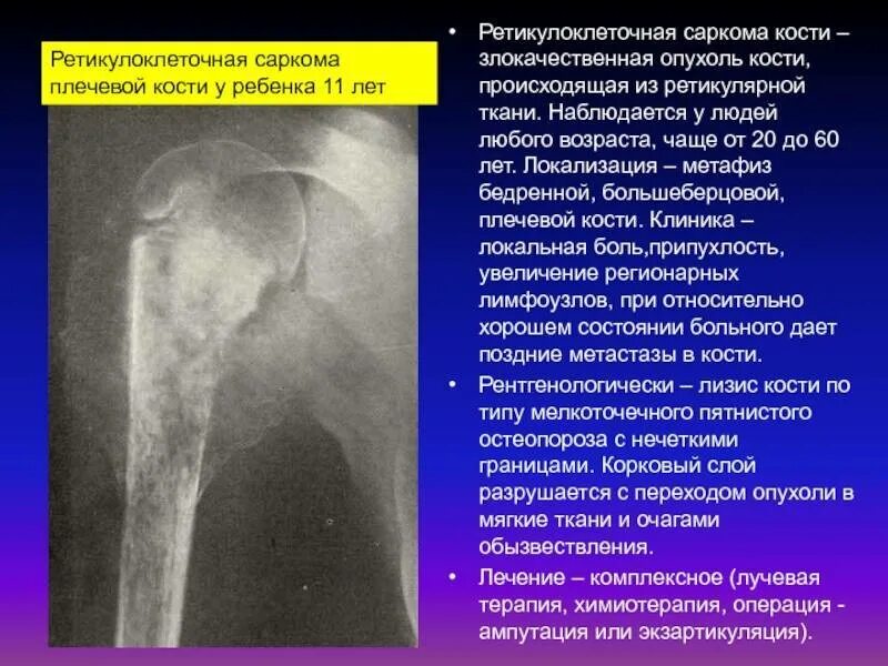 Рак в костях прогноз. Саркома Юинга плечевой кости рентген. Остеосаркома плечевой кости рентген. Саркома Эвинга плечевой кости рентген. Симптомы остеосаркомы бедренной кости.