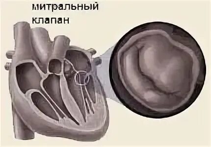 Кальциноз створок клапана