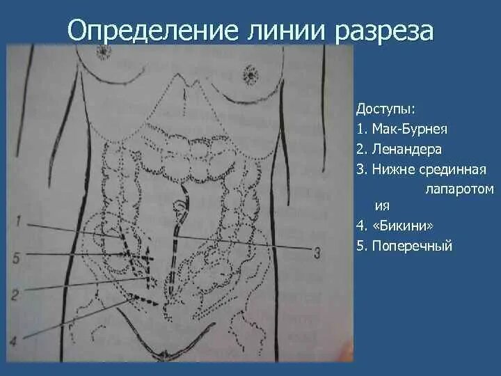 Точки аппендицита. Разрез Мак-Бернея-Волковича-Дьяконова. Разрез Волковича-Дьяконова в точке Мак-Бурнея. Волковича Дьяконова Мак Бурнея аппендэктомия. Точка Ланца и Мак Бурнея.