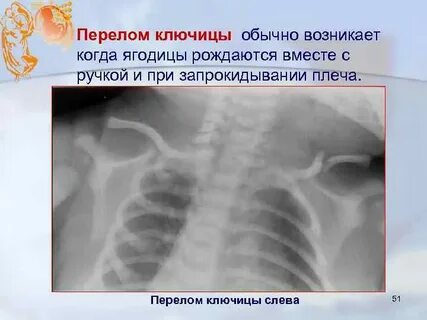 Ключица новорожденного