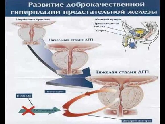 Профилактика аденомы предстательной железы у мужчин. Гиперплазия предстательной железы. Доброкачественная гиперплазия предстательной железы. Гиперплазия предстательной железы операция