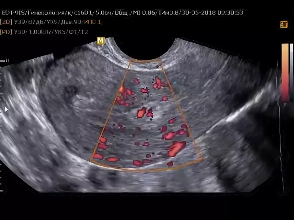 Эндометрия сосудов. Допплерография полипа эндометрия. Цветовое допплеровское картирование миома матки. Полип эндометрия с кровотоком.
