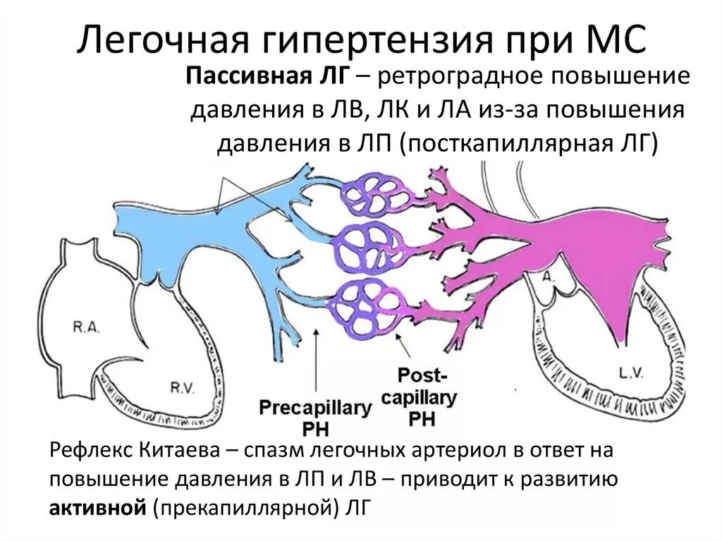 Легочно-венозная гипертензия стадии. Патогенез легочной артериальной гипертензии. Легочная артериальная гипертензия первичная. Патогенез развития легочной гипертензии.