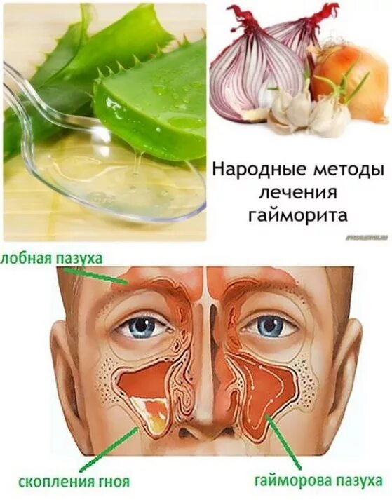 Эффективное лечение гайморита народными средствами. Синусит и гайморит лекарство.