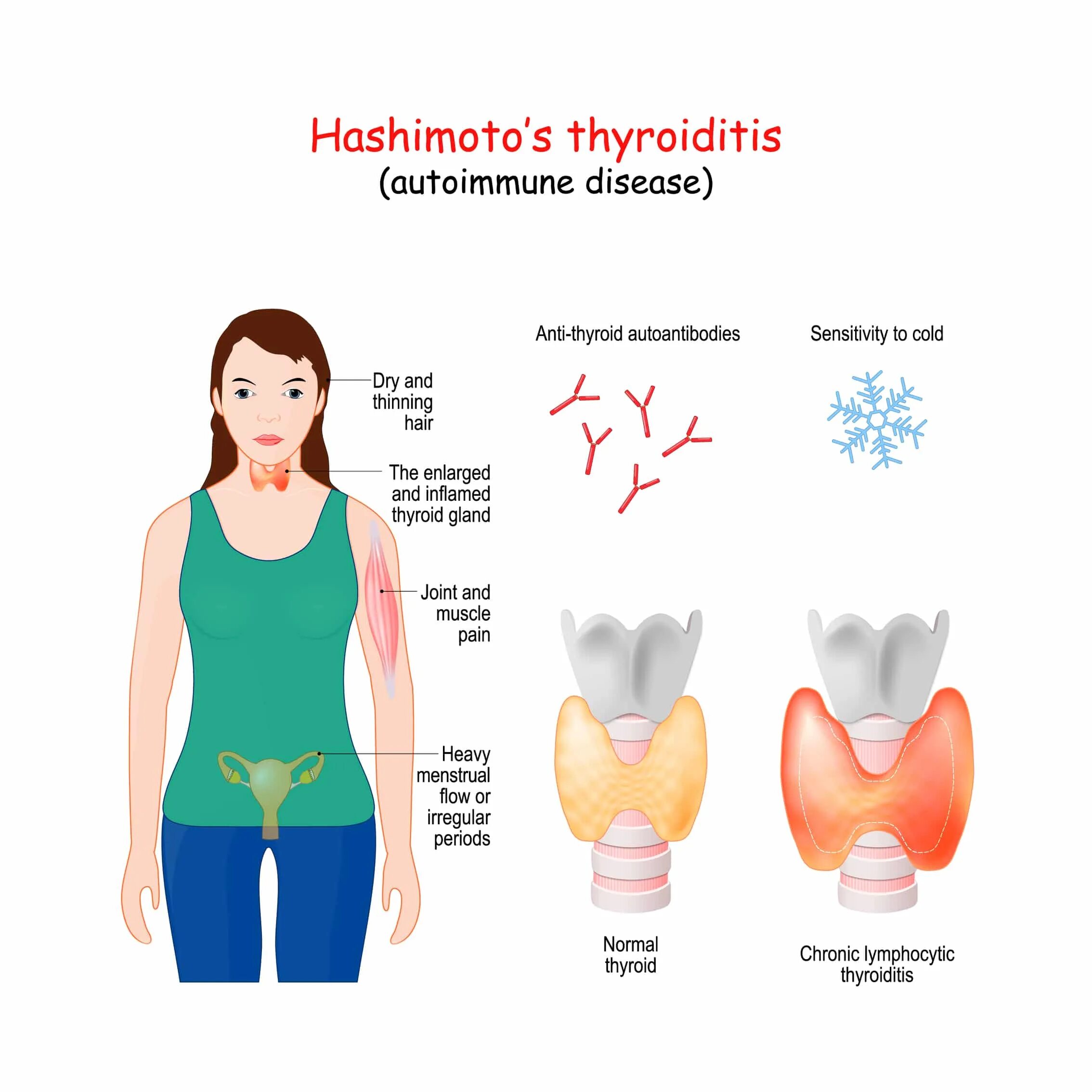 Хашимото болезнь у женщин. Хашимото щитовидной железы. Щитовидная железа болезнь Хашимото. Тиреоидита Хашимото щитовидной железы.