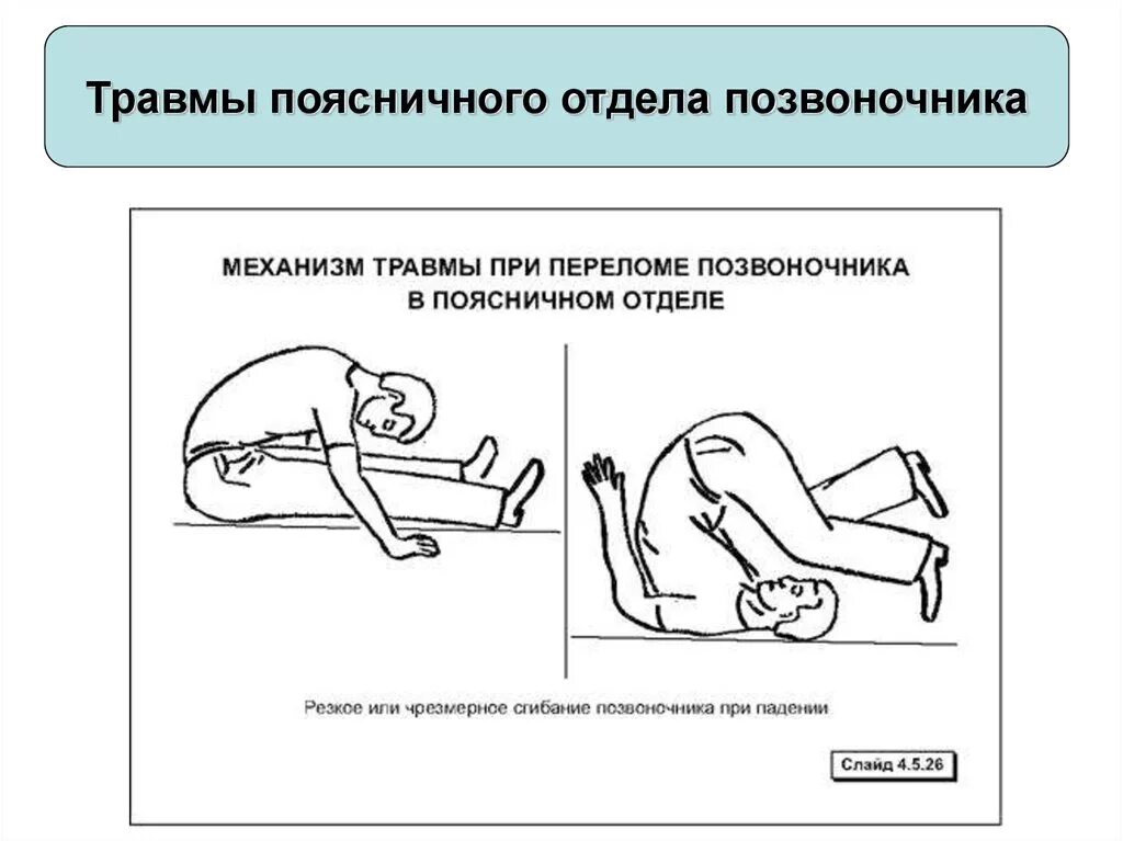 Травма поясничного отдела позвоночника. Механизмы травмы при переломах позвоночника. Переломы позвоночника механизм травмы. Сгибательный механизм травмы позвоночника. Повреждения в поясничном отделе позвоночника механизм.