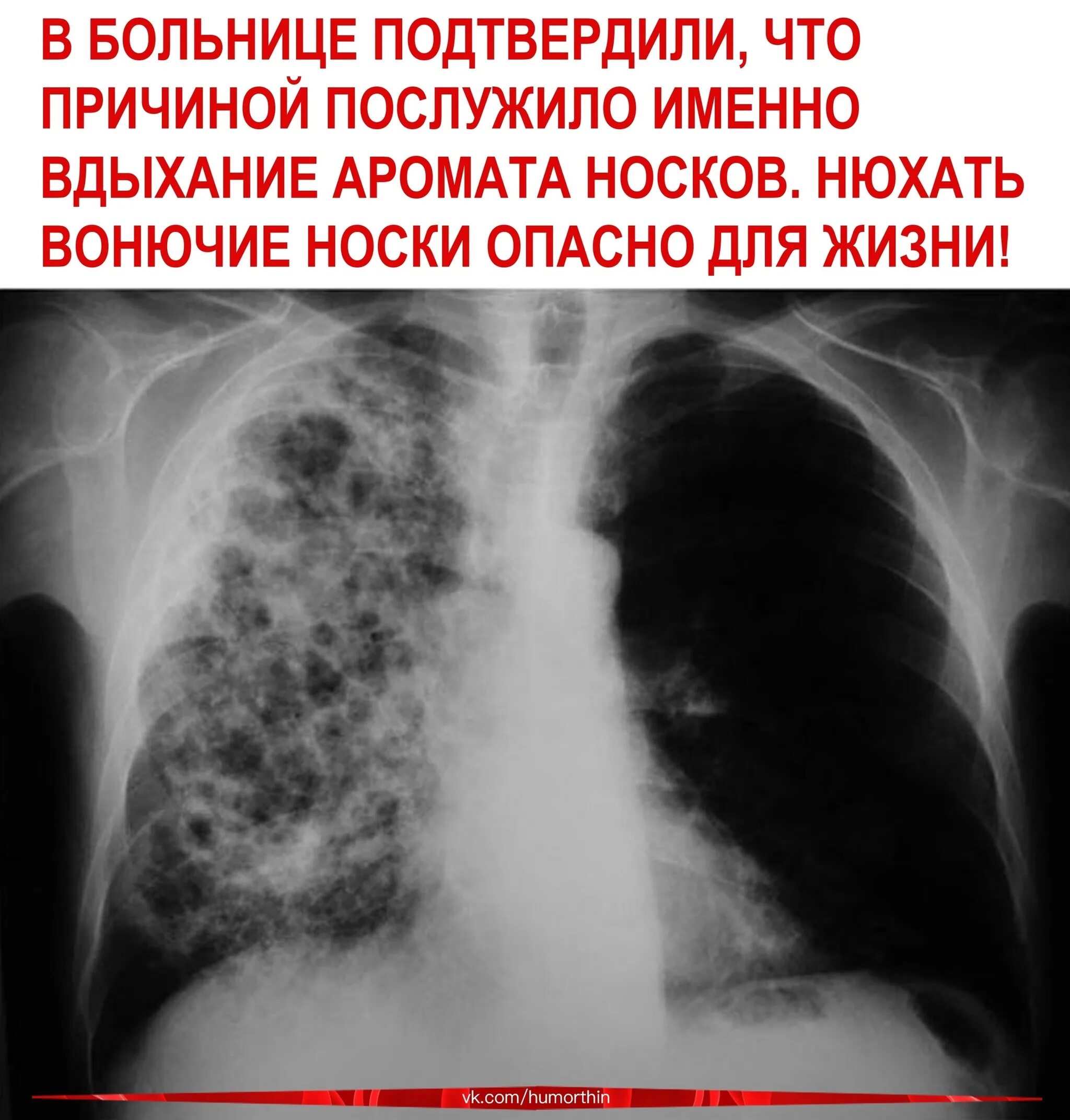 Пневмония легких опасно. Пневмония гистоплазма. Грибковое поражение легких.