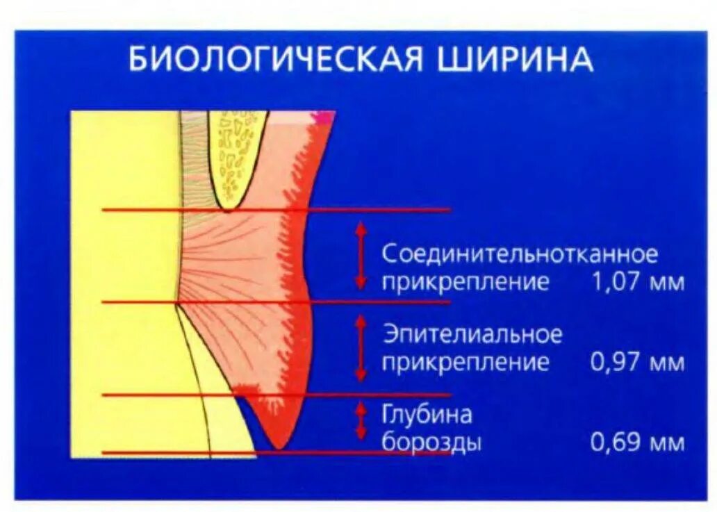 Биологическая ширина десны. Биологическая ширина зуба. Биологическая ширина в стоматологии. Биологическая ширина зуба в стоматологии. Прикрепленная десна