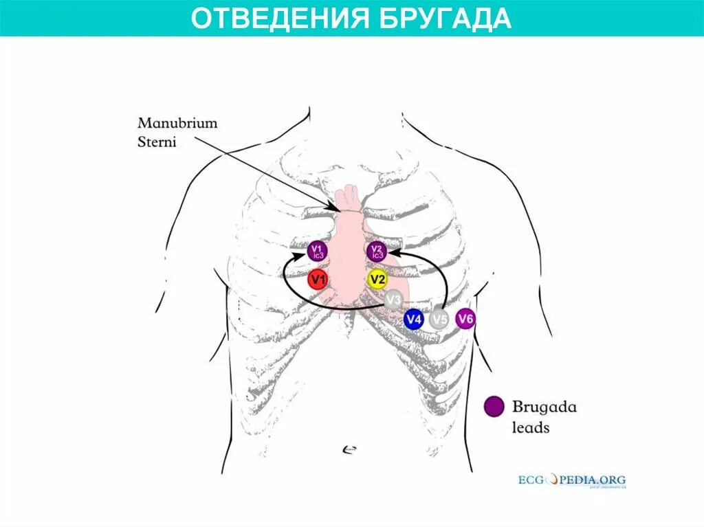 Холтер отведения. Холтер экг схема наложения электродов. наложение электродов v7-v9. экг отведения v7-v9. электроды экг схема наложения.