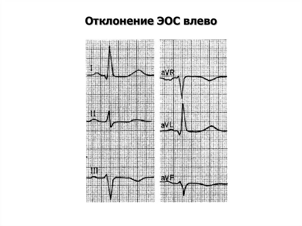 Электрическая ось влево на ЭКГ. Отклонение оси влево на ЭКГ. Отклонение электрической оси влево на ЭКГ. Отклонение ЭОС на ЭКГ. Сердце отклонено вправо