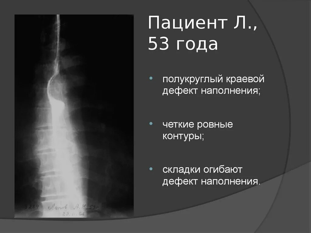 Код пищевода. Лейомиома пищевода рентген. Дефект наполнения пищевода при рентгенографии. Полип пищевода рентген.