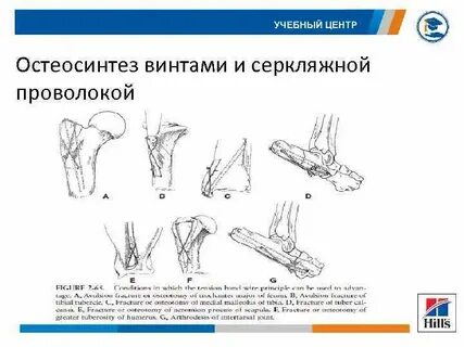 Остеосинтез по веберу локтевого