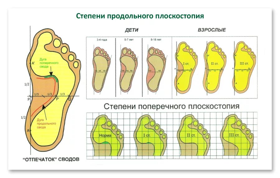 Продольно-поперечное плоскостопие и вальгус 3 степени. Плоскостопие 1 степени 2 степени. Продольно-поперечное плоскостопие градусы. Степени продольного и поперечного плоскостопия.