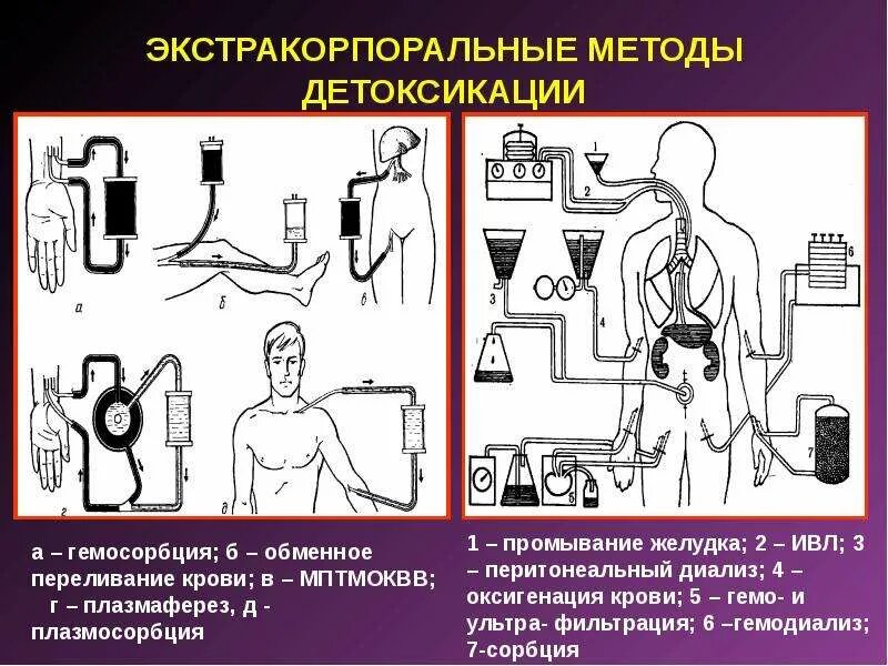 Гемофорез что это. Экстракорпоральный метод искусственной детоксикации это. Методы экстракорпоральной детоксикации гемодиализ. Интракорпоральный метод детоксикации при острых отравлениях. Экстракорпоральные методики детоксикации.