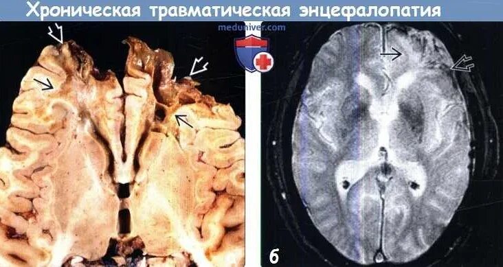 Гипертензионная энцефалопатия на мрт. Энцефалопатия токсического генеза. Острый геморрагический лейкоэнцефалит. Энцефалопатия головного мозга на мрт. Острая гипертоническая энцефалопатия мрт.
