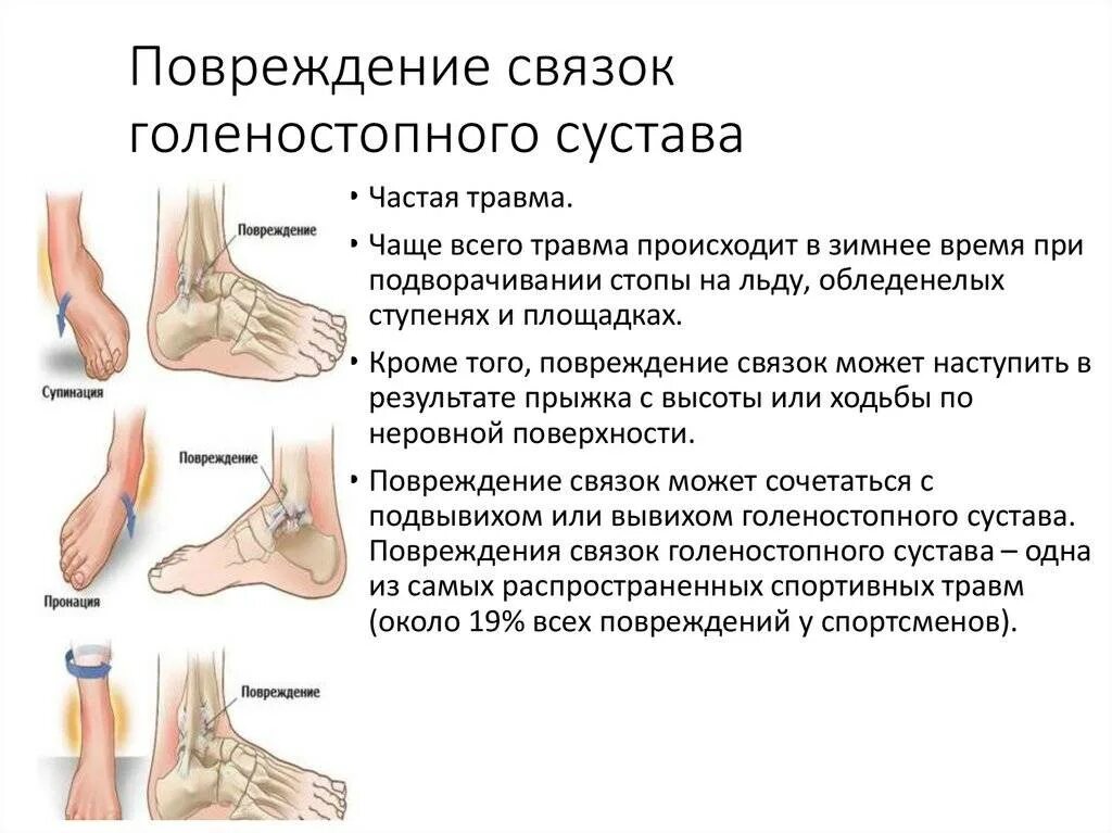 Лечение голеностопных суставов ног. Неполный разрыв связок голеностопного сустава. Связки голеностопного сустава анатомия разрыв. Ушиб сустава голеностопа растяжение. Разрыв связок голеностопного сустава симптомы.