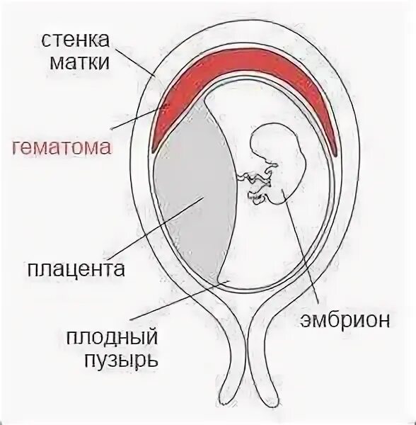 Как выходит гематома форум. Ретроплацентарная гематома. ретроамниотическая гематома. ретрохориальной гематомы при беременности.