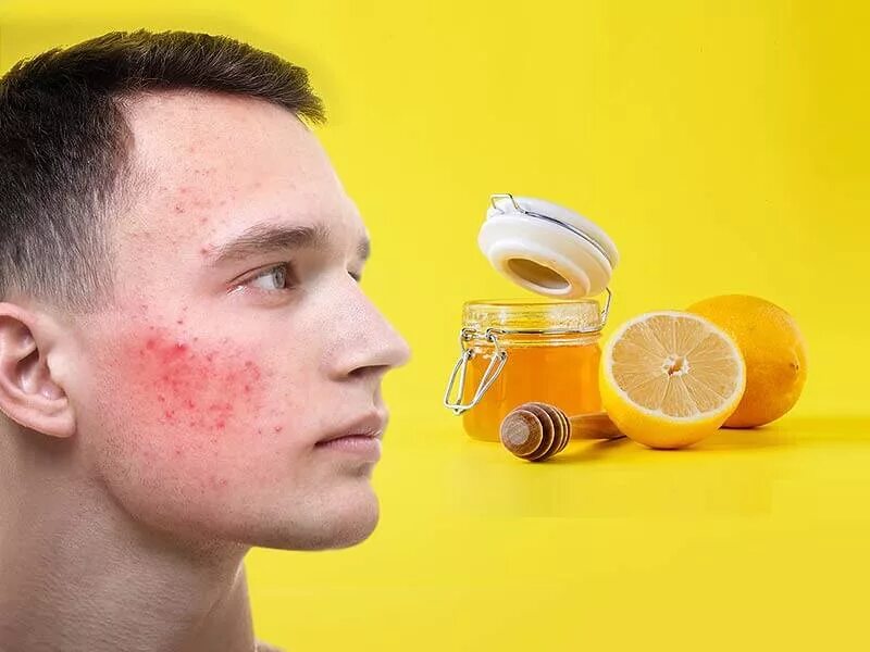Как избавиться от прыщей подростку. Какизбавится от прыщей на лице. прыщи на лице избавление. как избавиться от бришей.