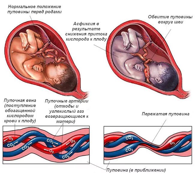 Обвитие пуповиной вокруг шеи. Обвития пуповины вокруг шеи плода. Схватки на 36 неделе