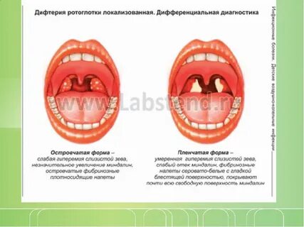 Материал на дифтерию