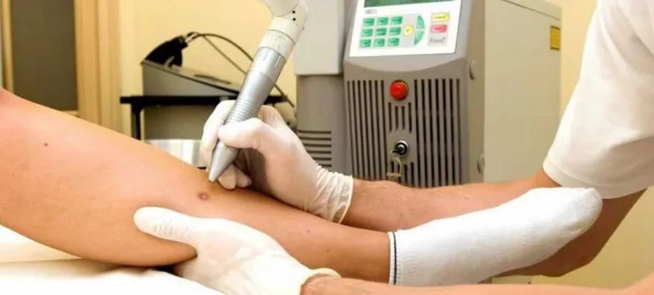 Удаление бородавок лазером ребенку. Лазерная коагуляция папиллом. деструкция бородавки лазером. электрокоагуляция бородавки. лазерное прижигание бородавок.