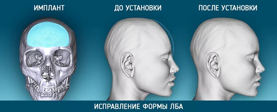 Исправление формы головы. Краниопластика черепа операция. нестандартная форма головы.