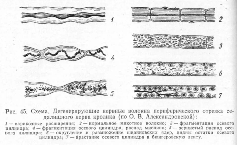 Повреждение нервных волокон. Регенерация нервного волокна схема. Типы повреждения нервных волокон. Регенерация нервных волокон в периферической нервной системе.