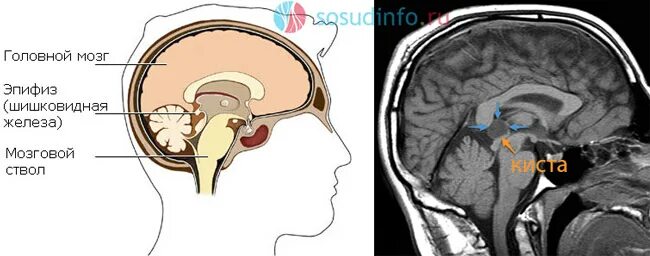 Чем опасна киста в мозгу. Арахноидальная киста эпифиза. Киста шишковидной железы головного мозга мрт. Шишковидная железа симптомы.
