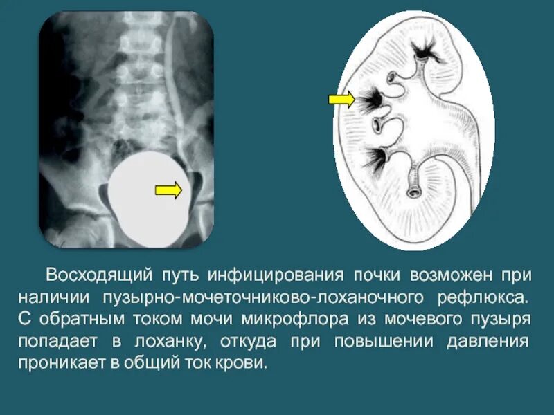 Что значит члс. Расширение чашечно-лоханочной системы почек на кт. Лоханочная система почки.