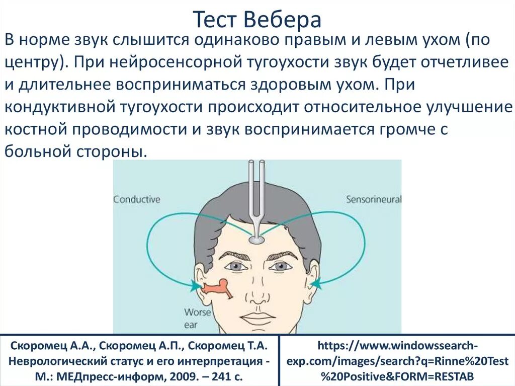 - Камертональные пробы Ринне, Вебера, Швабаха. Исследование слуха камертонами опыт Ринне опыт Швабаха Вебера. Тест Вебера и Ринне. Метод определения слуха с помощью камертонов.