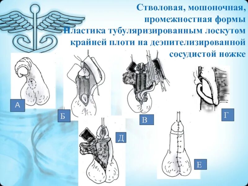 Эписпадия и гипоспадия. Гипоспадия классификация. гипоспадия стволовая форма у детей. мошоночно-промежностной гипоспадией. гипоспадия у детей презентация.