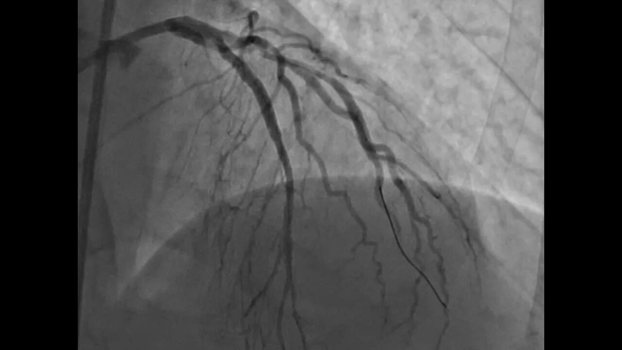 Стентирование сердца форум. Мэй-тернера стентирование. Стентирование тромбоз. Стентирование лка, пмжа. Стентирование через лучевую артерию.