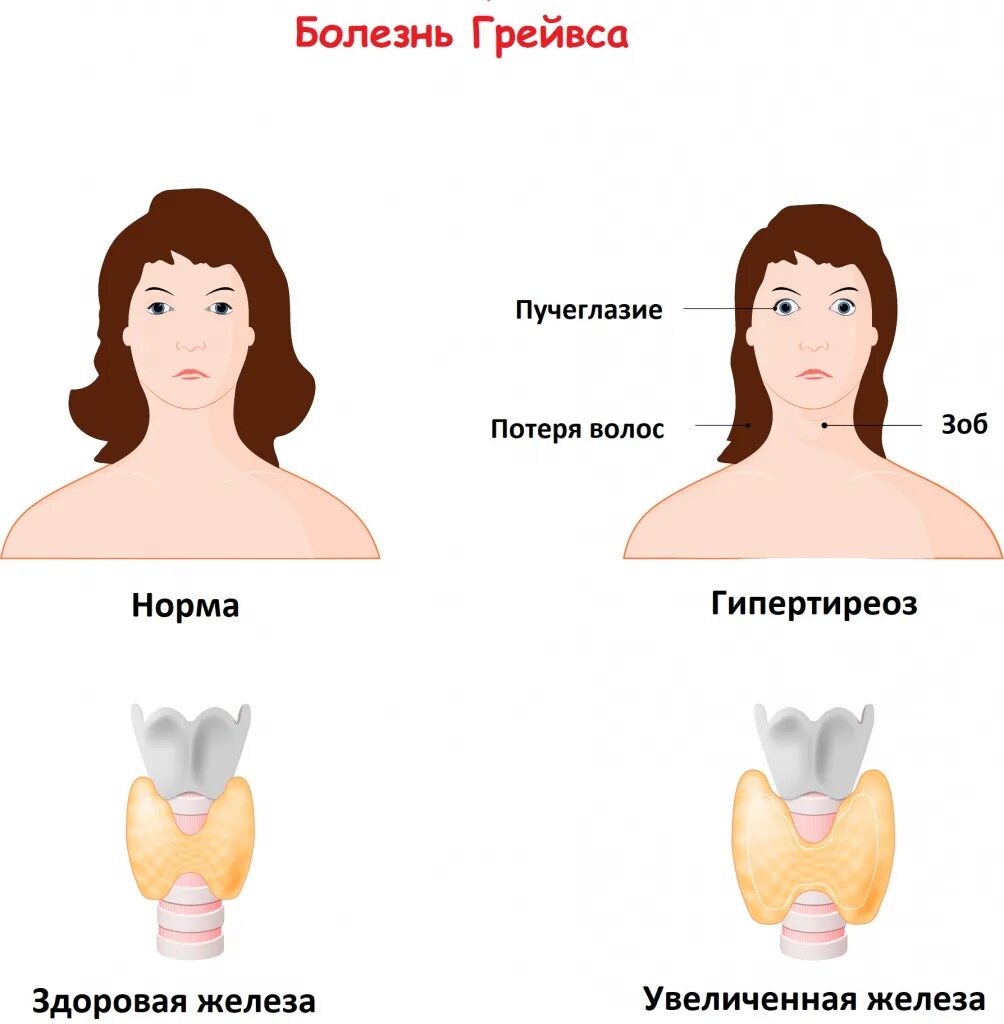 Можно ли с проблемами щитовидной. Диффузно-токсический зоб (болезнь Грейвса)педиатрия. Болезни щитовидной железы. Гипертиреоз щитовидной железы.