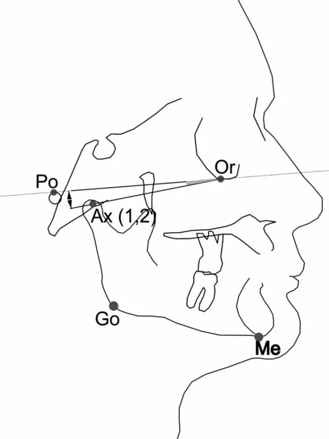 Новости и 1 точка. Точки ТРГ В ортодонтии. Углы ТРГ ортодонтия. Антропометрические точки ТРГ. Точка pt на ТРГ.