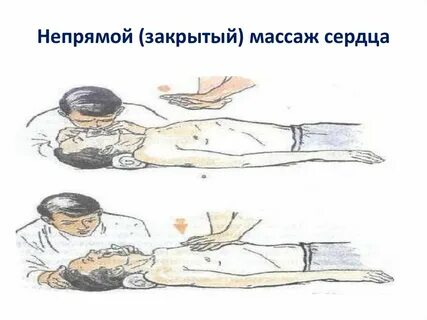 Закрыть массаж сердца