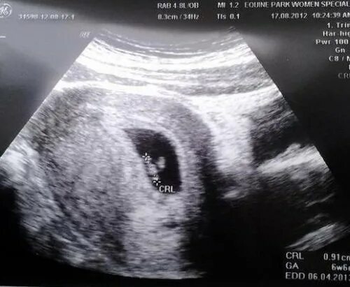 Снимок узи на 7-8 неделе беременности. Эмбрион на 7 неделе беременности узи. Узи ребенка на 7 неделе беременности. Эмбрион на 7 неделе беременности узи. Плод на 7 неделе беременности узи.