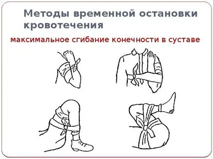 Схема остановки кровотечения