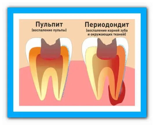 Пульпит или периодонтит. Периодонтит и пульпит разница. Периодонтит зуба шишка.